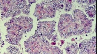 Thyroid Neoplasms  Pathology mini tutorial [upl. by Eidahs953]