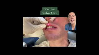 Lip Fordyce Spots Removal with CO2 Laser [upl. by Ettedranreb]