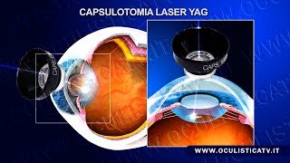 Cataratta secondaria capsulotomia laser YAG [upl. by Darahs51]