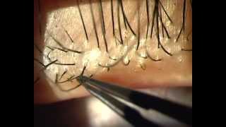 Demodex Blepharitis  Is it for real [upl. by Haraf]