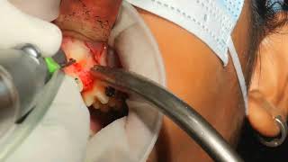 live impacted canine exposure for orthodontic extrusion [upl. by Ennayllek]