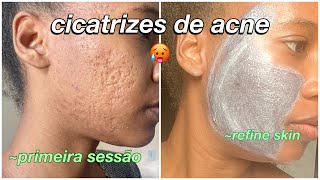 Cicatrizes de Acne  tratamento para remover cicatrizes refine skin [upl. by Debbi]