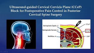 Ultrasoundguided Cervical Cervicis Plane CCeP Block [upl. by Ragucci]