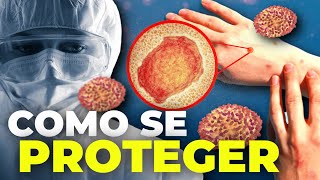 MPOX COMO SE PROTEGER [upl. by Sage]