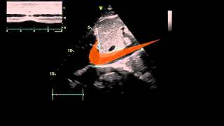 7 minutes IVC ultrasound part 1 [upl. by Ahsennod]