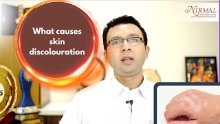 What causes skin discoloration  Dr KC Nischal  Dermatologists in Bangalore [upl. by Attiuqal354]