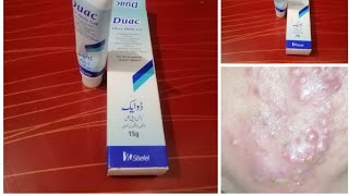 How to use Duac Gell for acne Best Gell for Acne remove Informative video for Acne treatment [upl. by Ymma]