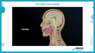 Att svälja med dysfagi [upl. by Leroj]