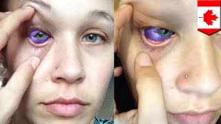 Eye tattoo gone wrong Models eyeball inking results in vision loss  TomoNews [upl. by Nivrek]