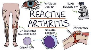 Understanding Reactive Arthritis [upl. by Denis]