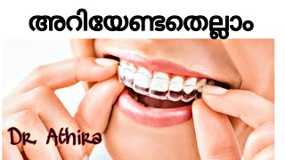 clear aligners malayalam  aligners  invisalign  invisalign aligners  pallil kambi idunnath [upl. by Dallas]