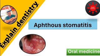 Aphthous stomatitis Lecture  Introduction  classification clinical features etiology Management [upl. by Danyluk]