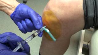 Norwich Podiatrist  Ostenil Plus injection of the knee  part 2 [upl. by Luigi]