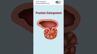 Homeopathic Medicine for Prostate Enlargement shorts prostateenlargement homeopathyasitis [upl. by Hsemar]