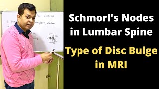 What are Schmorls Nodes in MRI Disc Bulge Lumbar Spine MRI Types of Herniated Disc shorts [upl. by Eiramlatsyrc]