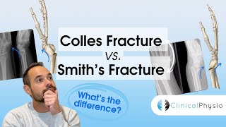 Colles Vs Smiths Fractures  Expert Physio Guide [upl. by Reave]