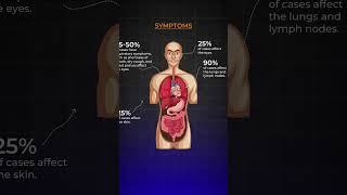 Know About Sarcoidosis I Akshar Pulmo Care sarcoidosis lungshealth science education [upl. by Armelda683]