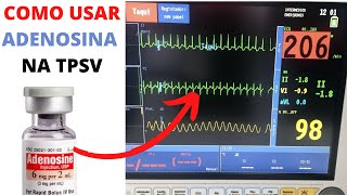 O que fazer na Taquicardia Supraventricular paroxística [upl. by Whorton276]