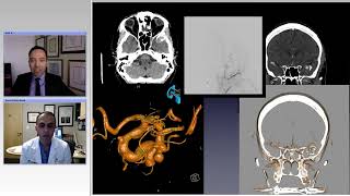 Revascularization Techniques for Treatment of Complex Aneurysms Preview [upl. by Ebarta623]