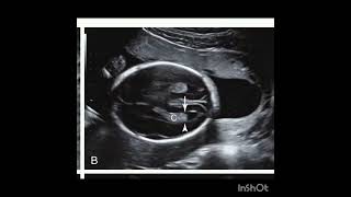 Ultrasound of Normal Fetal head Review of Chapter 15 from the book Requisites of Ultrasound [upl. by Yecac]