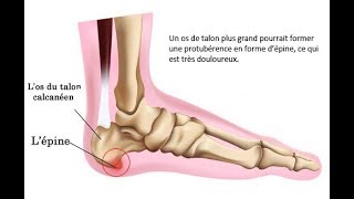 Comment faire pour prévenir une épine calcanéenne [upl. by Ittam]