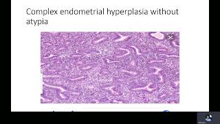 Endometrial hyperplasia Dr M Ramadan [upl. by Anirav]