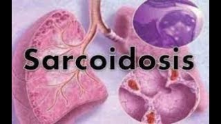 Sarcoidosis  sarcoidosis lung disease  sarcoidosis treatment  sarcoidosis radiology  symptoms [upl. by Kuhn]