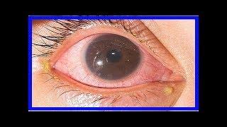 Trachom  Konjunktivitis durch Chlamydien verursacht [upl. by Laverna]