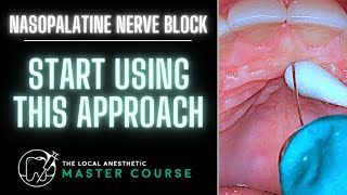 How to Do A Nasopalatine Nerve Block  Online Dental Continuing Education  LocalAnestheticcom [upl. by Asecnarf]