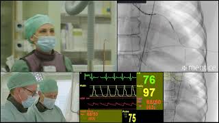 Interventional Cardiology  Left main PCI perforation complication management  VR simulation [upl. by Cymbre]