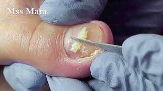 Mss Mara Ep22  Toenail relief now Incredible sharp nail under toenail Podología Integral [upl. by Havener]