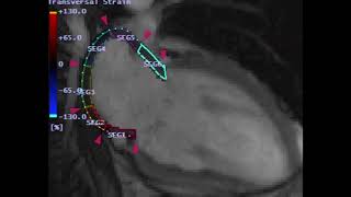 Afib Catheter Ablation Biomarker – Two Chamber View [upl. by Meibers]