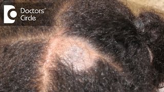 What causes Scalp Ringworm Effective Treatment   Tinea Capitis  Dr Tina Ramachander [upl. by Annawoj]