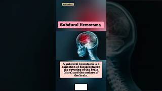 Brain Hemorrhage  Subdural Hematoma [upl. by Nicolette124]