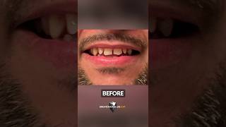 See How He FIXED His Gapped Teeth with SnapOn Veneers [upl. by Hsinam]