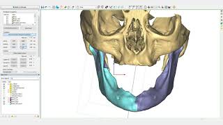 La Reconstruction Mandibulaire  PROPLAN CMF™ [upl. by Rasec]