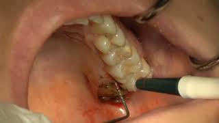 Palatal Fibrous Hyperplasia Excision [upl. by Dun170]