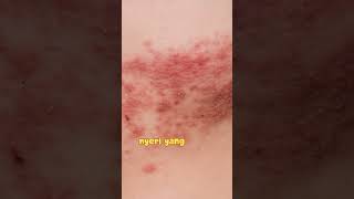 post herpetic neuralgia nyeri setelah kena herpes [upl. by Nnylaehs876]