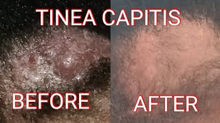 TINEA CAPITIS UPDATE [upl. by Hodge300]