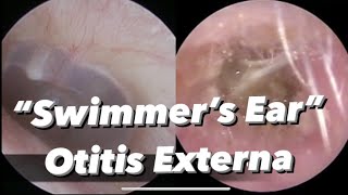 Otitis Externa  Swimmers Ear  infection of the outer ear ear canal [upl. by Blim56]