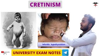 Cretinism  Hypothyroidism  Endocrine Physiology [upl. by Hastings]