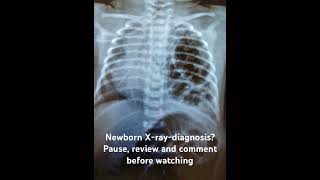 Newborn Xraydiagnosis Pause review and comment [upl. by Ria]