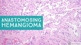 Anastomosing Hemangioma 101Explained by a Soft Tissue Pathologist [upl. by Eenhat556]