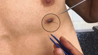 PULLING INGROWN HAIRS REMOVAL for mr Đạt Long Vinh ASMR [upl. by Nalyorf947]