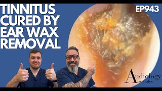 TINNITUS CURED BY EAR WAX REMOVAL  EP943 [upl. by Marlyn294]