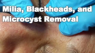 Milia Blackheads and Microcyst Removal [upl. by Greg]