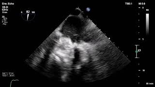 Mechanical Mitral Valve Prosthesis Thrombosis Thrombolytic Therapy [upl. by Eicak]