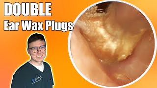 “Unbelievable difference”  Hearing TRANSFORMED after removing two plugs  Ear Wax Removal Ep 10 [upl. by Elocan]