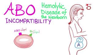 ABO Incompatibility  Hemolytic Disease Of The Newborn HDN  Hematology amp Pathology [upl. by Krissy]