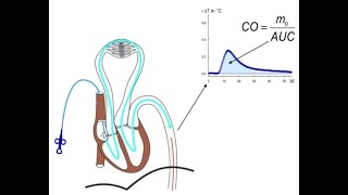 Is TPTD Transpulmonary Thermodilution Obsolete in context of POCUS [upl. by Hey]